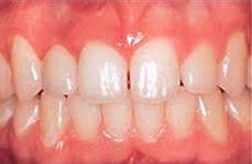 Dental Implants_After