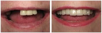 before-and-after-cosmetic-dentistry-and-implants