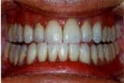 patient_veneers_after_teeth