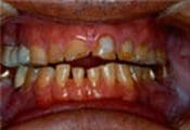 patient_veneers_before_teeth