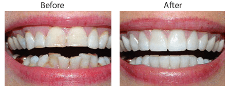 Dental Contouring Before and After Pictures in Atlanta, GA - Smile
