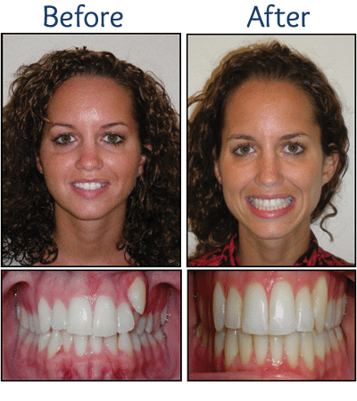 Invisalign Before and After Pictures in Atlanta, GA - Smile Envy